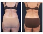 Liposuction