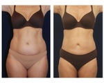 Liposuction