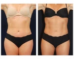 Liposuction