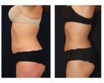 Liposuction