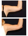 Liposuction