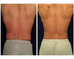 Liposuction