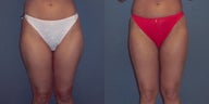 Tumescent Liposuction