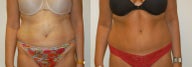 Tummy tuck