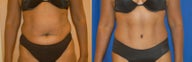 Tummy tuck
