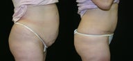 Tummy tuck
