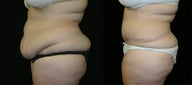 tummy tuck