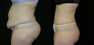 tummy tuck