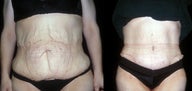 tummy tuck