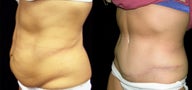 tummy tuck