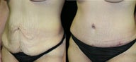 tummy tuck