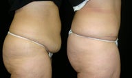 tummy tuck