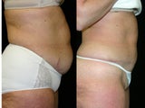 tummy tuck