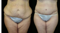 tummy tuck