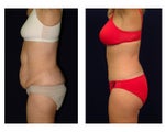 Tummy Tuck or Abdominoplasty