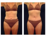 Tummy Tuck or Abdominoplasty