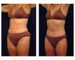 Tummy Tuck or Abdominoplasty