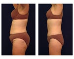 Tummy Tuck or Abdominoplasty