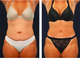 Tummy Tuck / Abdominoplasty