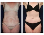 Tummy Tuck or Abdominoplasty