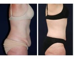 Tummy Tuck or Abdominoplasty