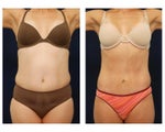 Tummy Tuck or Abdominoplasty