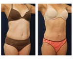 Tummy Tuck or Abdominoplasty