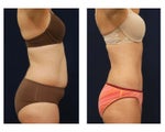 Tummy Tuck or Abdominoplasty