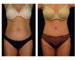 Tummy Tuck / Abdominoplasty