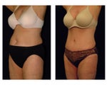 Tummy Tuck / Abdominoplasty