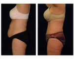 Tummy Tuck / Abdominoplasty