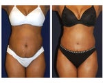 Tummy Tuck / Abdominoplasty