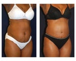 Tummy Tuck / Abdominoplasty
