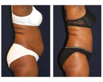 Tummy Tuck / Abdominoplasty