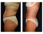 Tummy Tuck / Abdominoplasty
