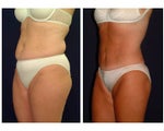 Tummy Tuck / Abdominoplasty