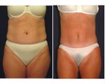 Tummy Tuck / Abdominoplasty