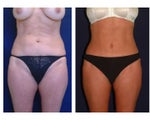 Tummy Tuck / Abdominoplasty