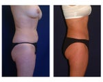Tummy Tuck / Abdominoplasty