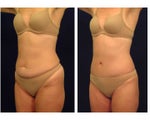 Tummy Tuck / Abdominoplasty