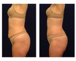 Tummy Tuck / Abdominoplasty
