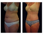 Tummy Tuck / Abdominoplasty