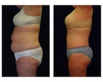 Tummy Tuck / Abdominoplasty