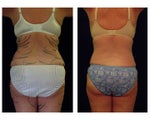 Tummy Tuck / Abdominoplasty