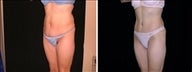Full tummy tuck, liposuction of back, flanks, and medial thighs