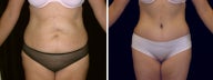 39 year old woman full tummy tuck