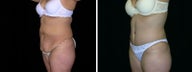 45 year old woman full tummy tuck