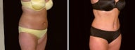 50 year old woman, full tummy tuck