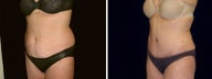 49 year old woman, full tummy tuck