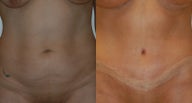 Tummy tuck